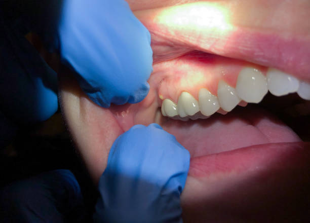 Best Root Canal Emergency Dentist  in Pearl River, LA